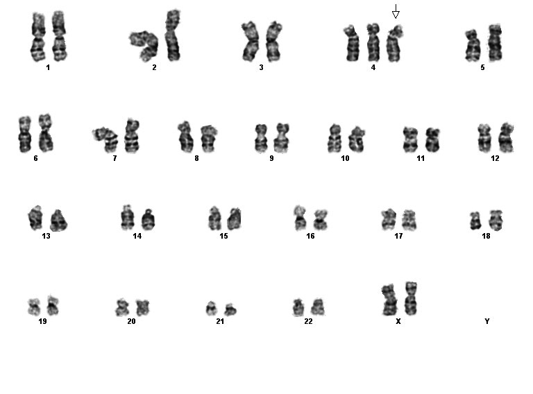 Karyotype showing trisomy 4